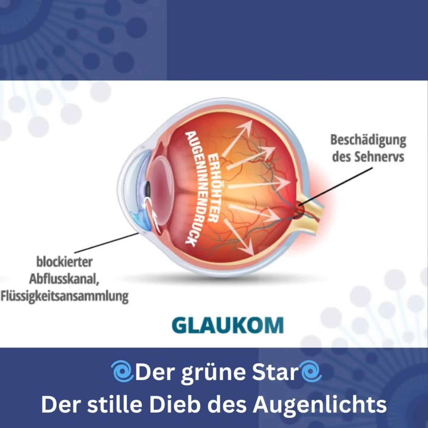 Grafische Darstellung des Glaukoms mit Augenschäden und Sehnerv-Beschädigung.