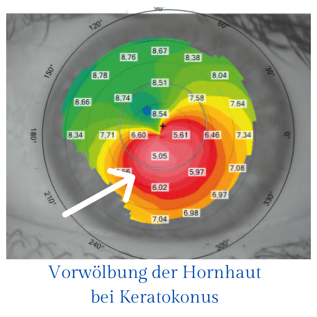 Hornhauttopographie mit Farbskala bei Keratokonusdiagnose.