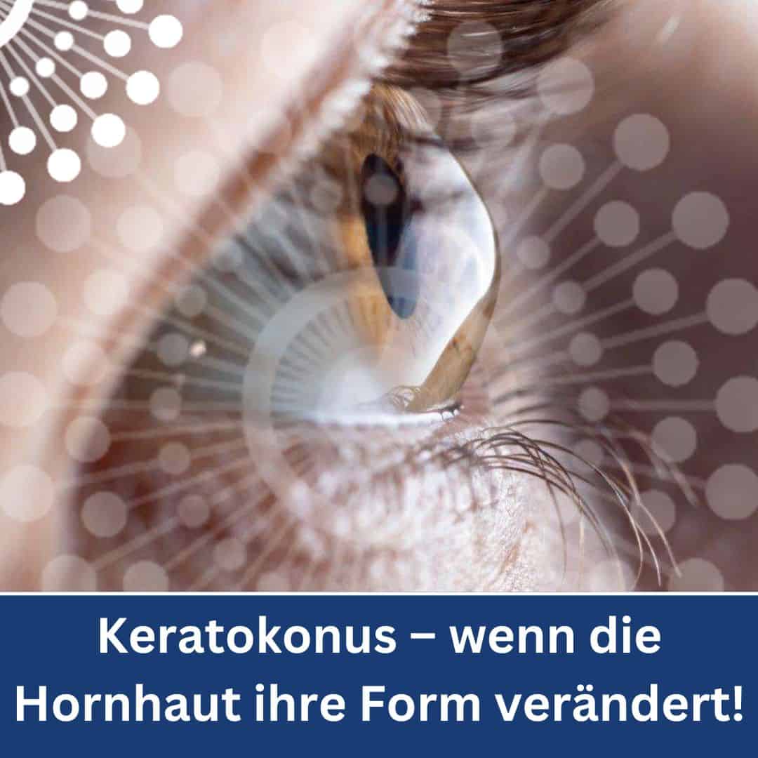 Nahaufnahme eines Auges mit Keratokonus, Hornhautverformung sichtbar.