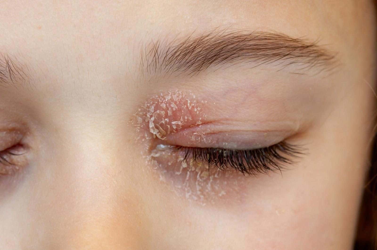 Nahaufnahme eines geröteten, entzündeten Augenlids bei Lidrandentzündung (Blepharitis)